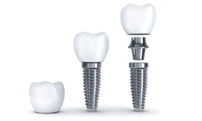 Dental Implants